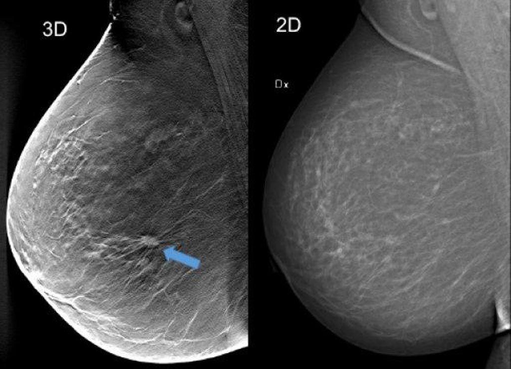 mammografiya.jpg