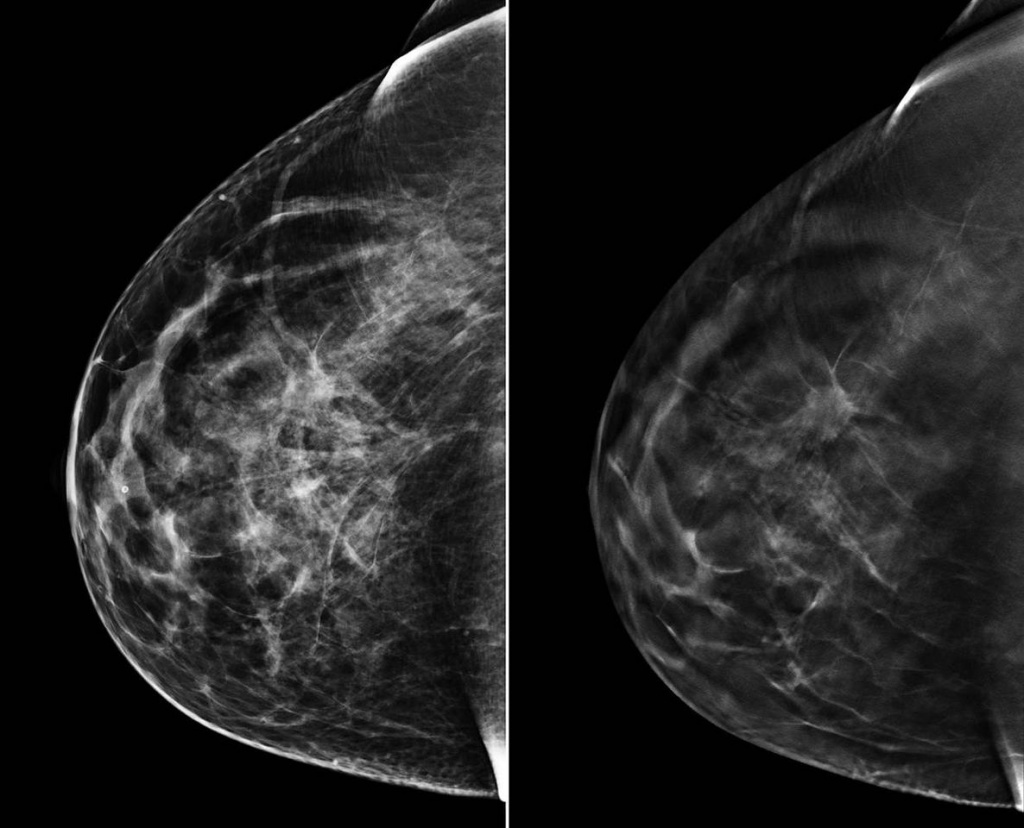 breast-cancer-and-mammogram-results-1.jpg